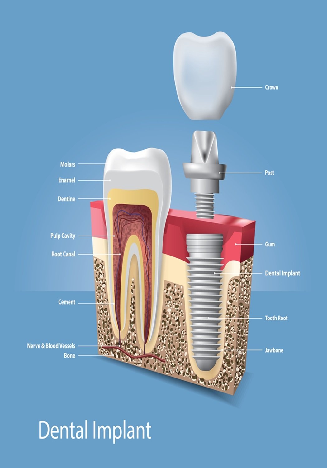 Dental Implant